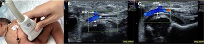 Ultrasound to guided epicutaneo-caval catheter insertion in newborn infants